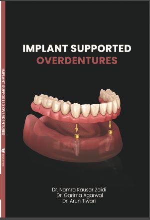 Implant supported Overdentures 